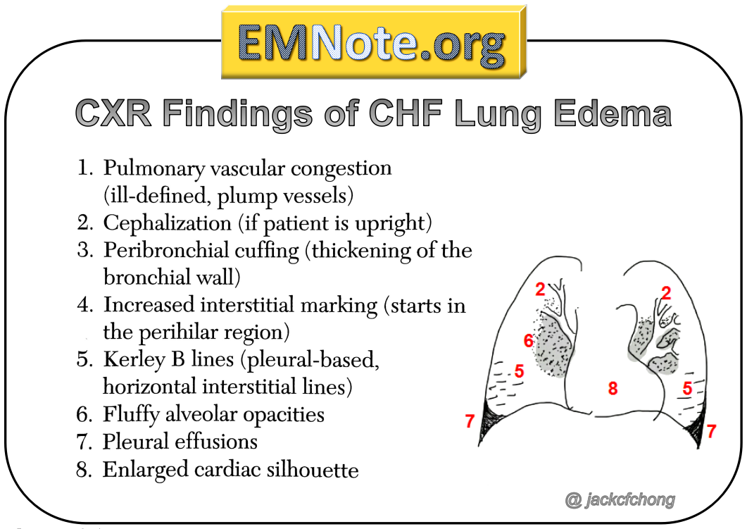 pulmonary edema chf chest x ray